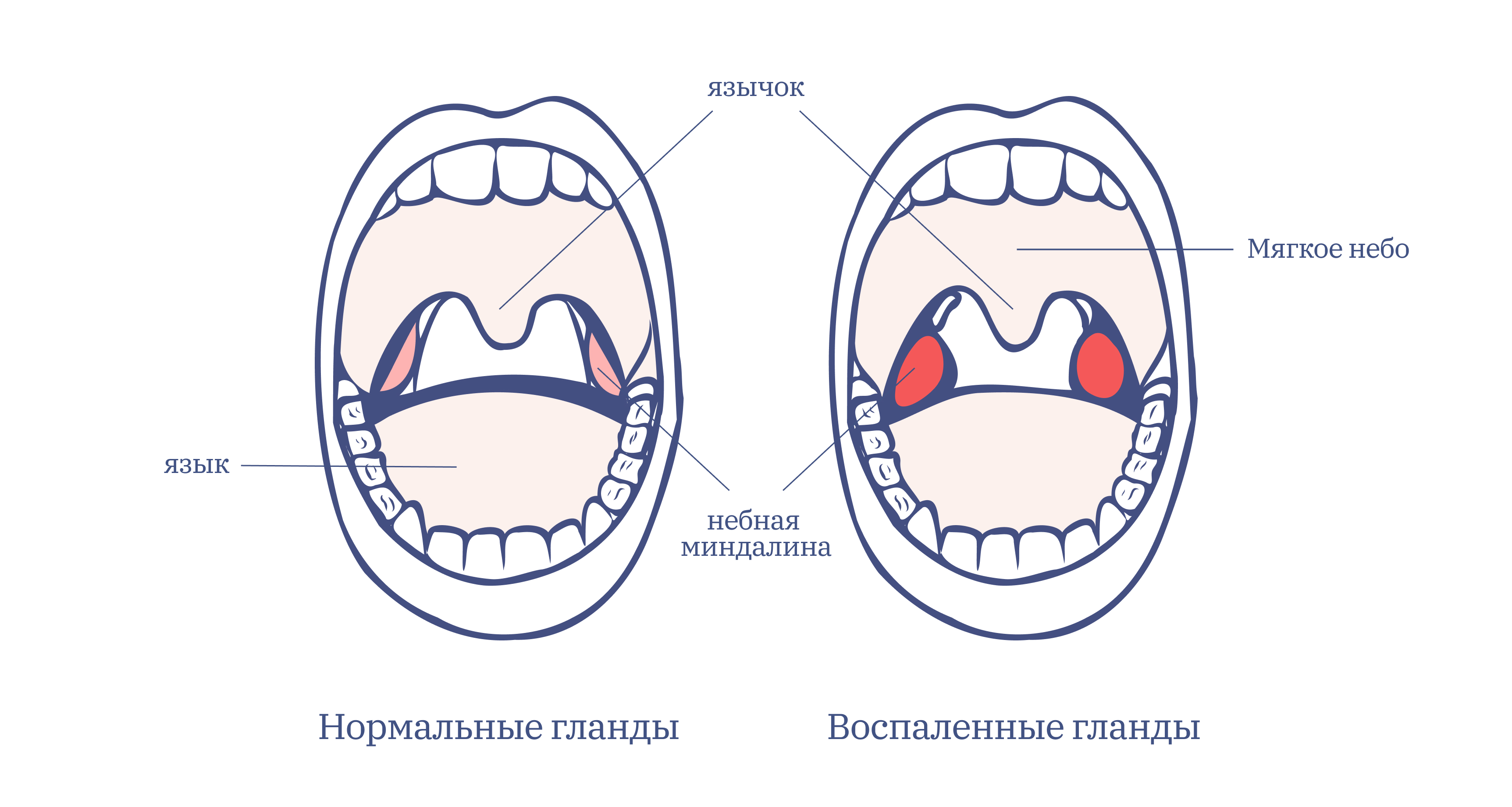 Миндалины — защита на пути инфекций
