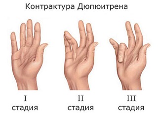 Контрактура Дюпюитрена