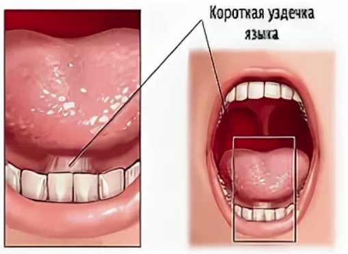 Короткая уздечка языка