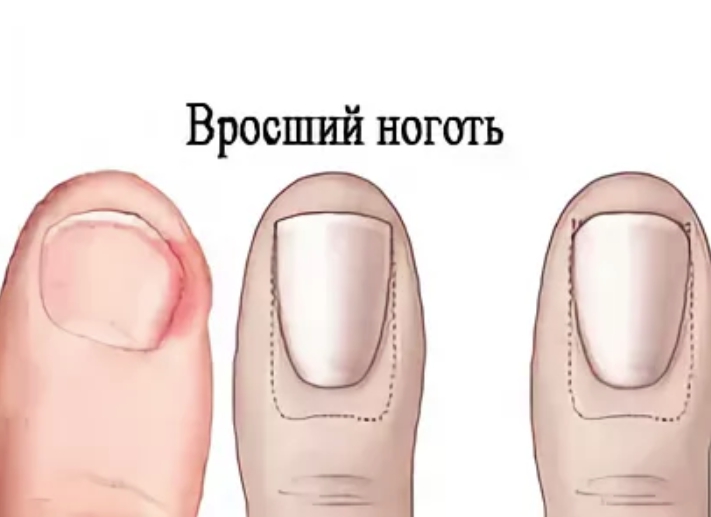 Вросший ноготь