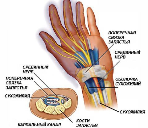 Туннельный синдром карпального канала