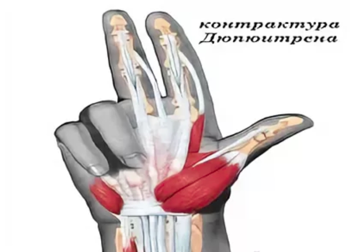 Дюпюитрен