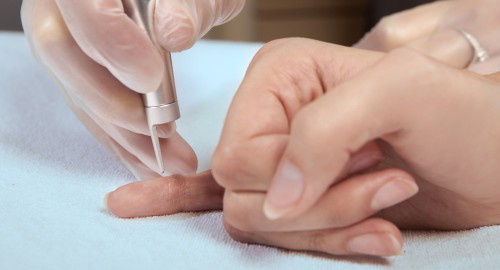 Удаление новообразований