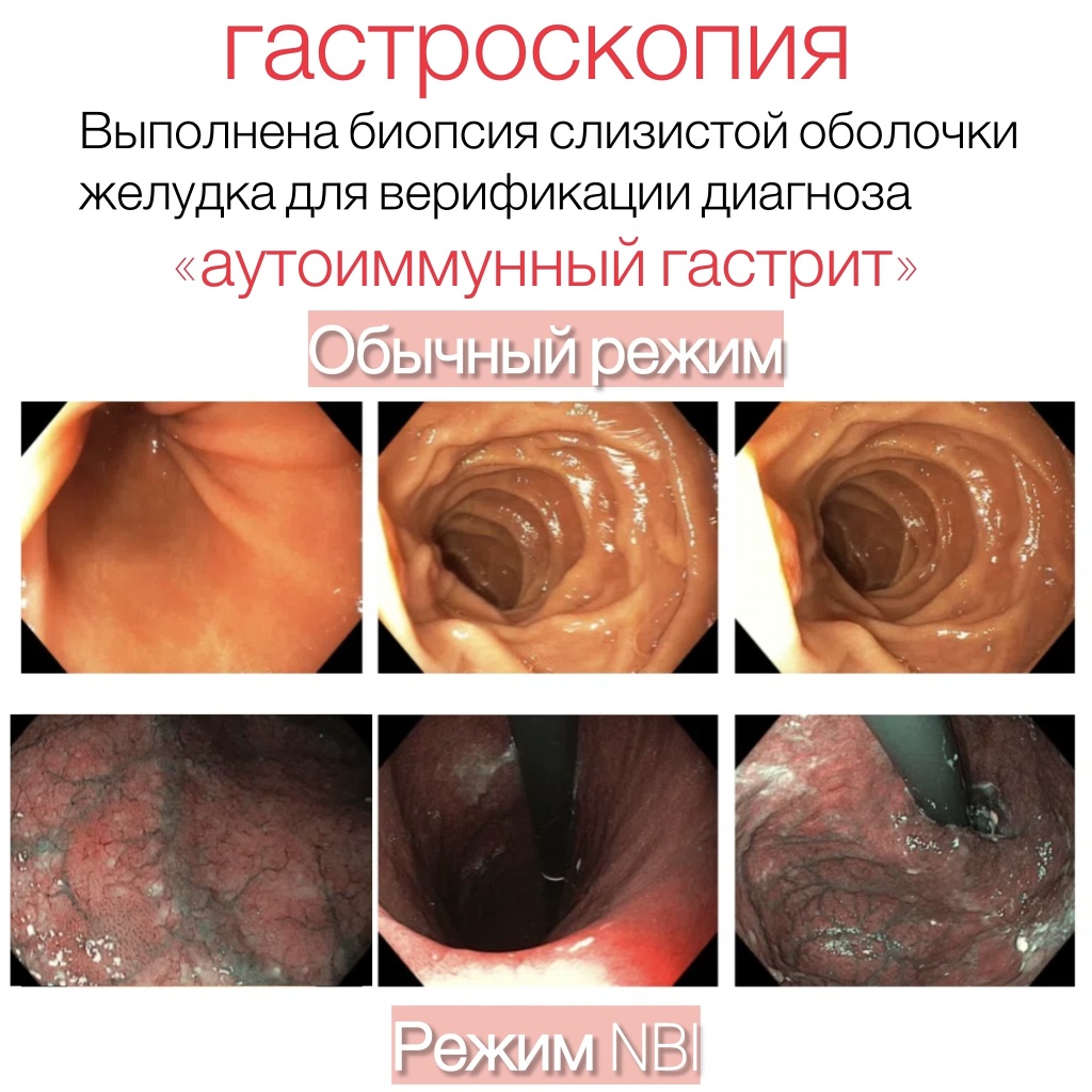 Биопсия слизистой оболочки желудка для верификации диагноза