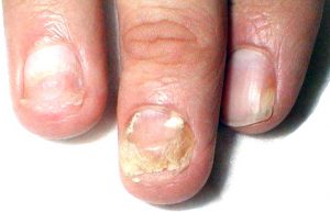 onychomycosis-300x193.jpg