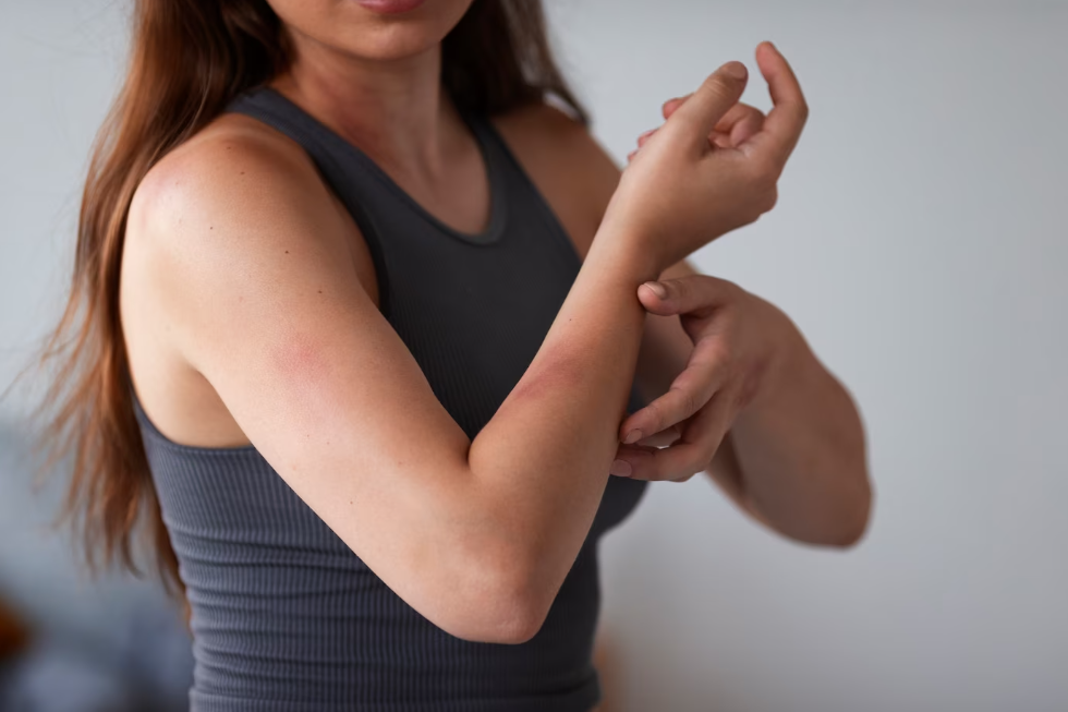 Эритема, виды и лечение.