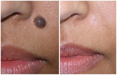 Лазерное удаление родинок, бородавок (фото: до и после)