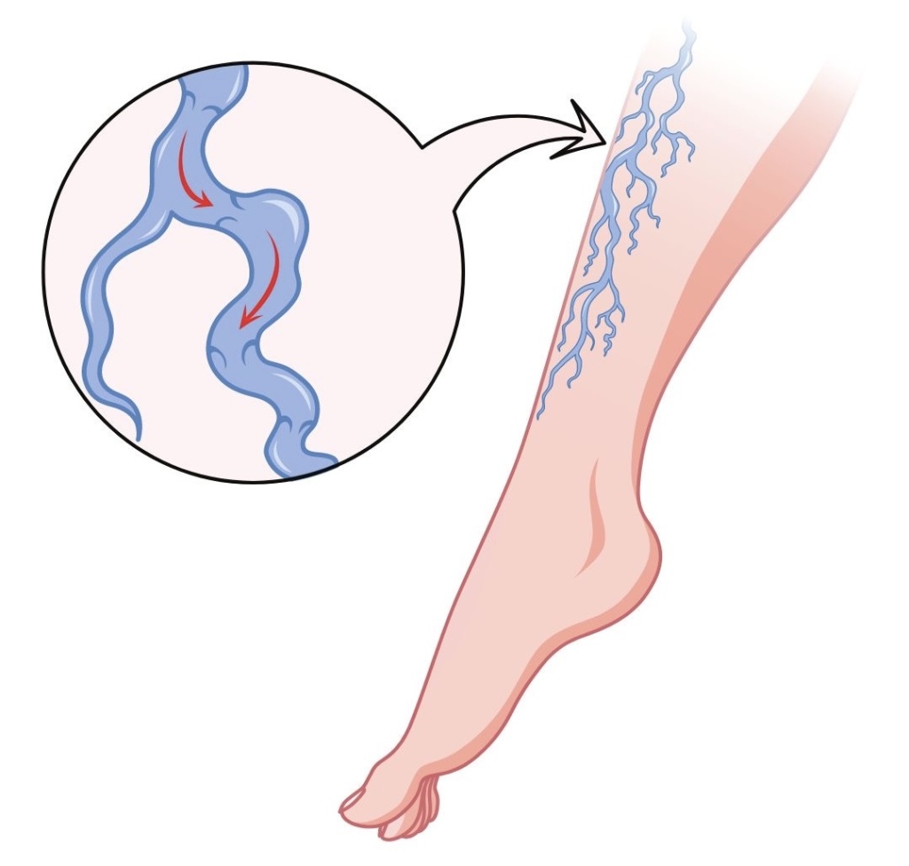 Атеросклероз: причины, опасности и лечение в Доктор Боголюбов 