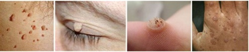Мягкие фибромы, вирусные бородавки
