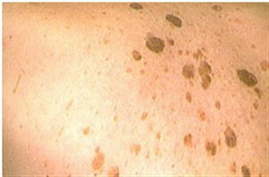 Себорейные кератомы