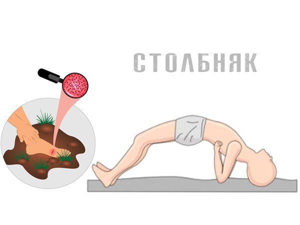 Столбняк