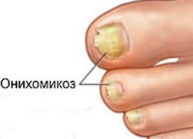 Отомикоз