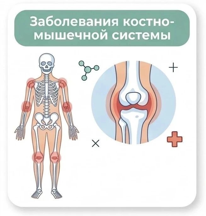 Заболевания костно-мышечной системы
